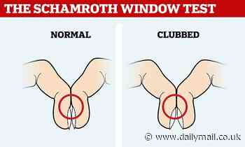 Schamroth window: Simple finger test that 'can reveal cancer'