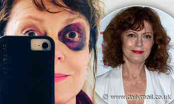 Susan Sarandon shows a black eye from her concussion as she admits she's 'lucky' to have healthcare