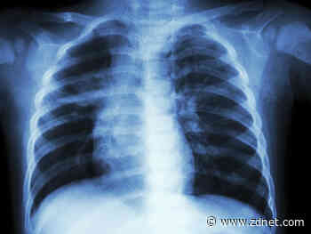 Peter MacCallum Cancer Centre completes IBM Watson trial for lung cancer patients