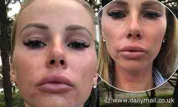 The Bachelor: Rachael Arahill's lips get even bigger as she suffers severe allergic reaction