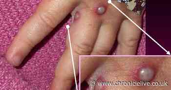 What is monkeypox and what are the symptoms? Person in England diagnosed with condition