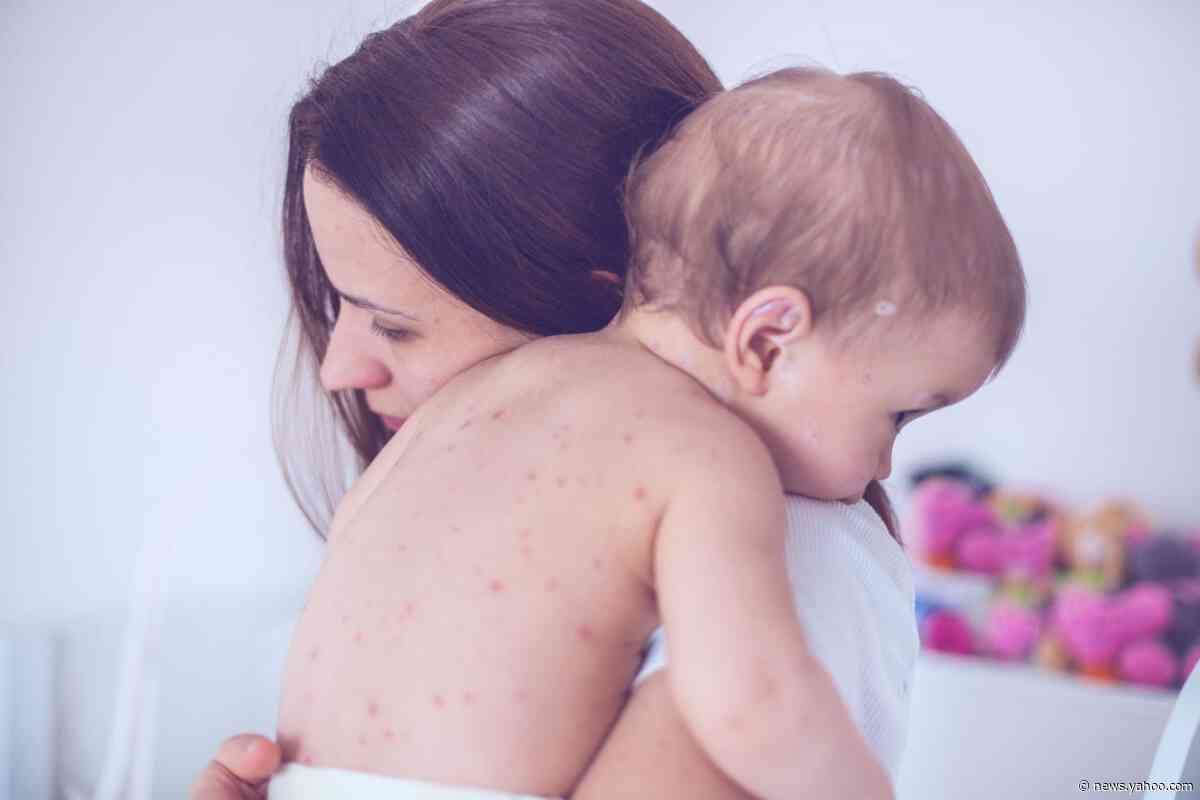 Measles killed more than 140,000 amid stagnating vaccine rates
