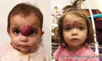 Toddler, one, with facial tumor that was covering her eye undergoes surgery to remove it in the US