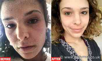 Shocking before and after pictures of eczema-stricken student with steroid withdrawal