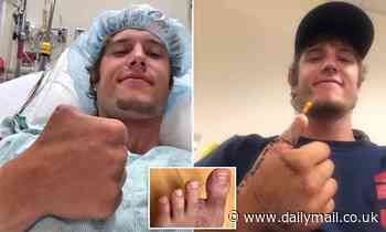 Surgeons use man's TOE to replace his thumb after he sawed it off