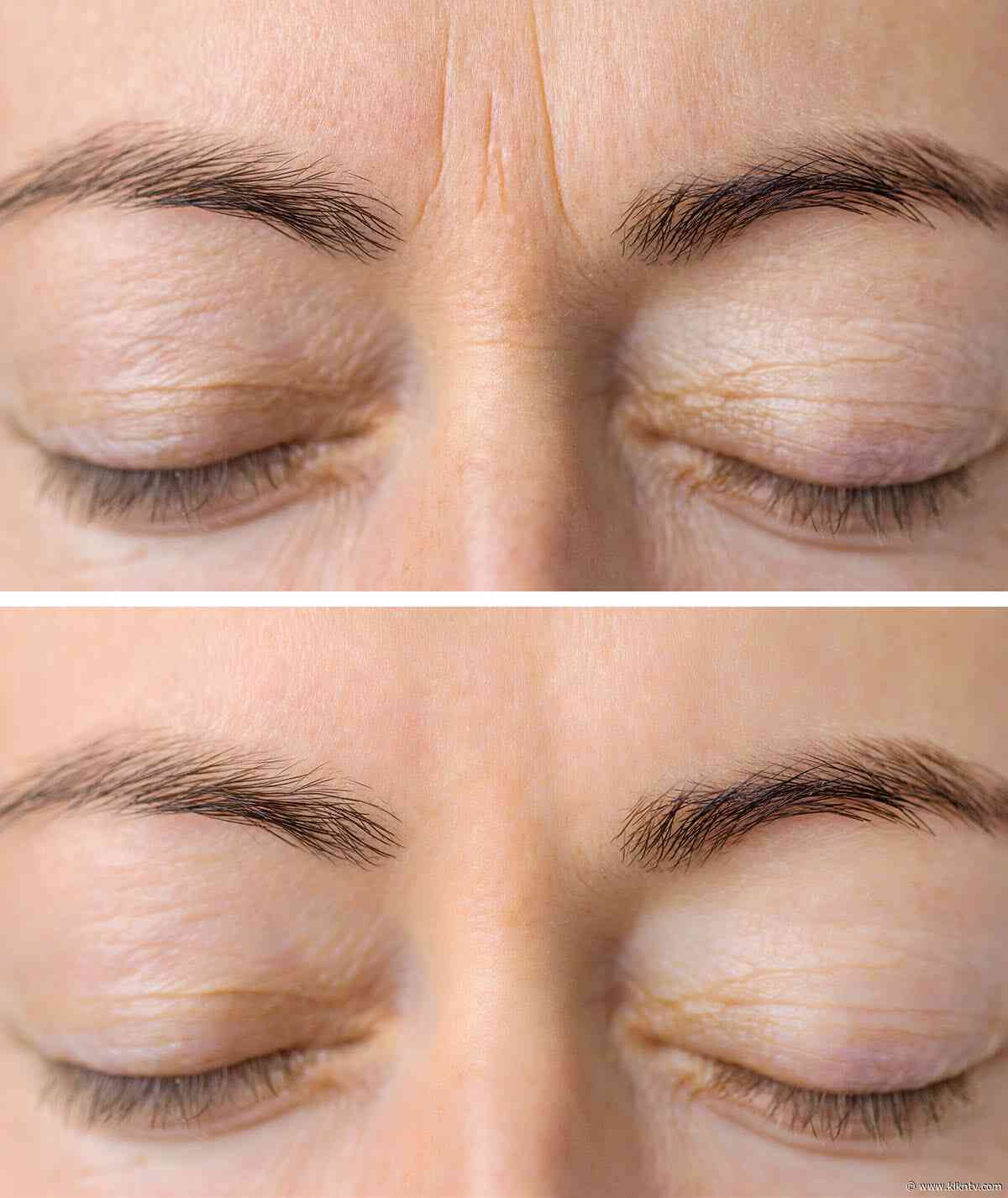 Surgery for Drooping Eyelids Can Take Years Off Your Appearance