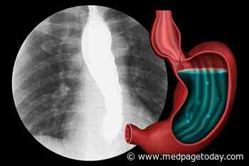 Less Invasive Approach as Good as Surgery for Achalasia
