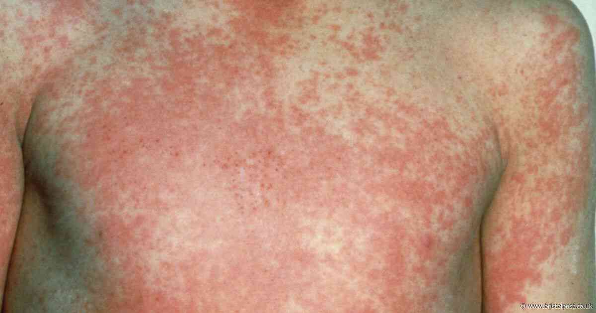 Multiple cases of Scarlet Fever confirmed near Bristol