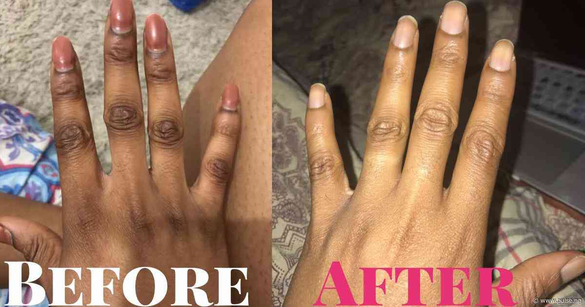 You can clear your dark knuckles with baking soda lime...here's how