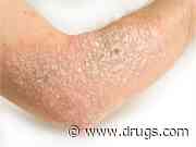 Type 2 Diabetes More Common in Patients With Psoriasis