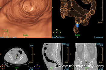 Trio of CT Features Predict Sigmoid Colon Cancer Recurrence