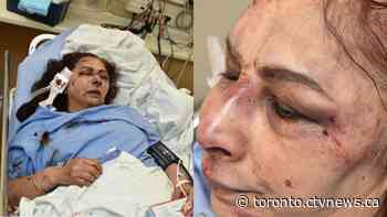 Police release images of victim's serious injuries after 'appalling' home invasion in Thornhill