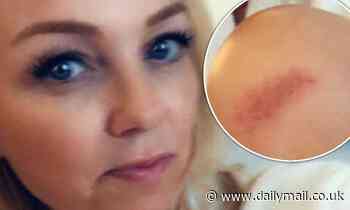 Emma Bunton shares a glum-faced snap after she grazes her knee falling from her bicycle