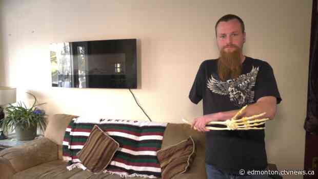 This Edmonton man had his arm amputated. Then he had it taxidermied.