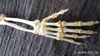 With taxidermist's help, Alberta man preserves bones of his amputated arm