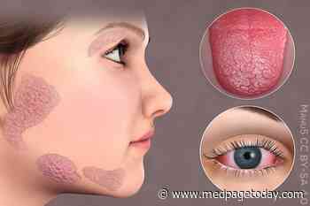 Sjogren's Phenotype: It's Not Just One Thing