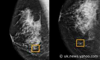 AI system outperforms experts in spotting breast cancer