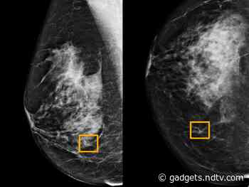Google AI System Could Aid Breast Cancer Detection, Study Finds