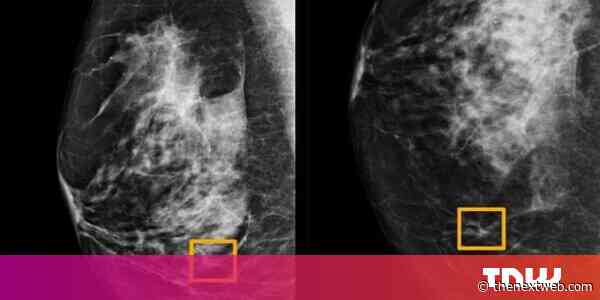 Google’s new AI detects breast cancer just by scanning X-ray