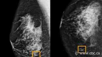 AI detects breast cancer as accurately as expert radiologists, study finds