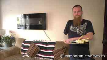 This Edmonton man had his arm amputated. Then he kept the bones.