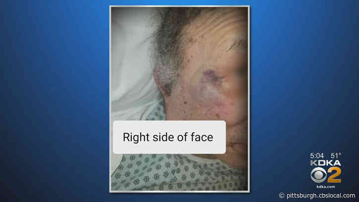 Woman Says 82-Year-Old Father With Dementia Was Assaulted By Employee At McKeesport Nursing Home