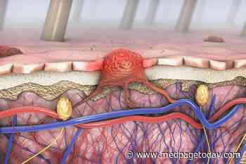 Checkpoint Toxicities Tied to Better Outcomes in Melanoma