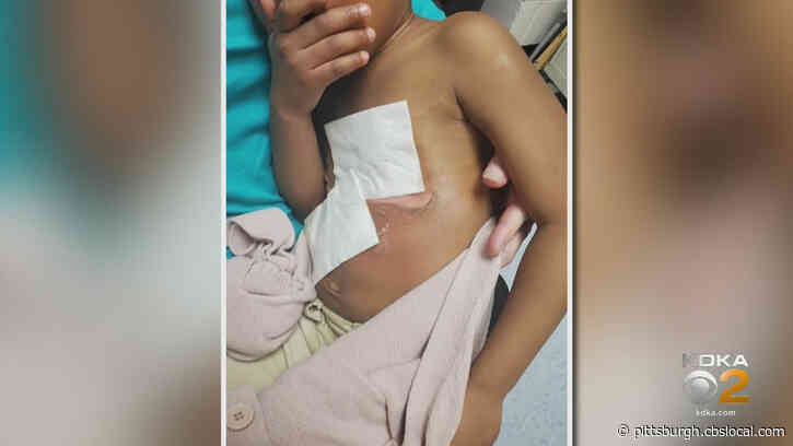Family: 5-Year-Old Girl Recovering After Classroom Project Gone Wrong Leaves Her With Second-Degree Burns