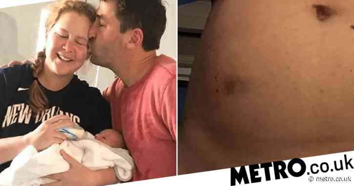 Amy Schumer reveals bruising from IVF as she admits feeling ‘emotionally run down’
