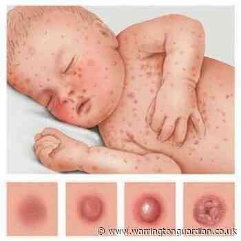 Children with chickenpox should never be given ibuprofen or nurofen