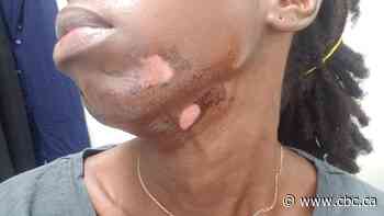 'I felt like it was on fire': Woman burned by laser hair removal warning others to do their research