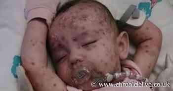 This is why you should never use ibuprofen to treat a child’s chickenpox