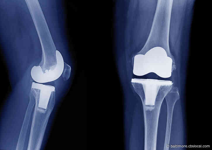 Most People Wait Too Long For Knee Replacement Surgery, Study Says