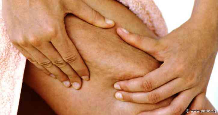 Get rid of cellulite for good with these homemade remedies