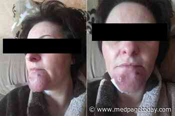 What Is Causing This Woman's Swollen Chin?