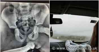 Shocking X-ray shows why you should never put your feet on the dashboard in a car