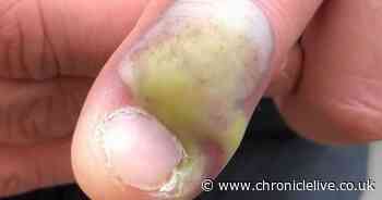 Woman's stark warning to nail biters after friend contracts deadly infection