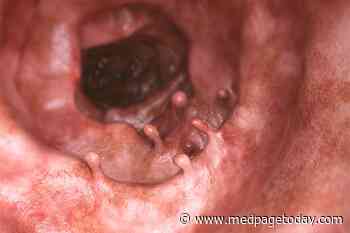 AI System Improved Colonoscopy Quality, Adenoma Detection
