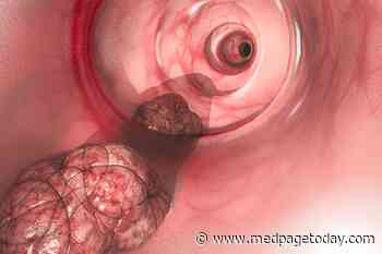 More Fuel for the Colon Cancer Screening Age Debate