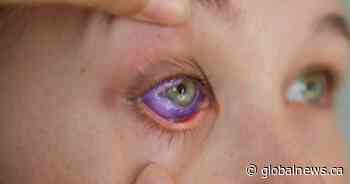 Saskatchewan government bans cosmetic eye tattooing, jewelry implantation