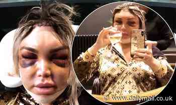Roddy Alves sips on champagne as she gets her hair styled despite sporting a VERY bruised face