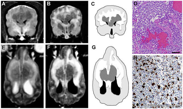 What Is Glioblastoma? How Scientists Are Working To Cure This Aggressive Form Of Cancer