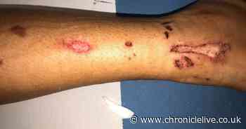 Teenage girl suffers serious burns after friends set fire to wheelie bins in Durham