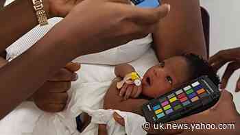UK doctors develop low-cost jaundice detection app to check newborns