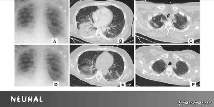 Alibaba’s new AI system can detect coronavirus in seconds with 96% accuracy