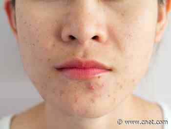 How to get rid of acne, according a dermatologist     - CNET