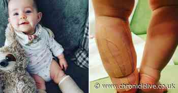 Baby born with 'clubbed foot' and 'giraffe shaped' birthmark diagnosed with rare genetic mutation
