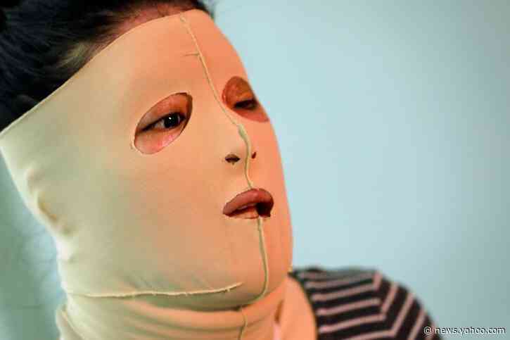 Mexican woman who survived acid attack calls on others to speak out without fear