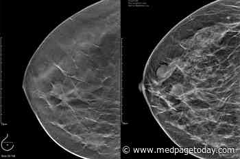 Study: DBT Breast Screening Benefits Sustained Long-Term