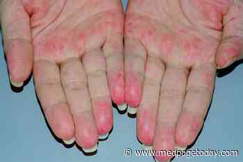 In Vasculitis, Beware of Infection